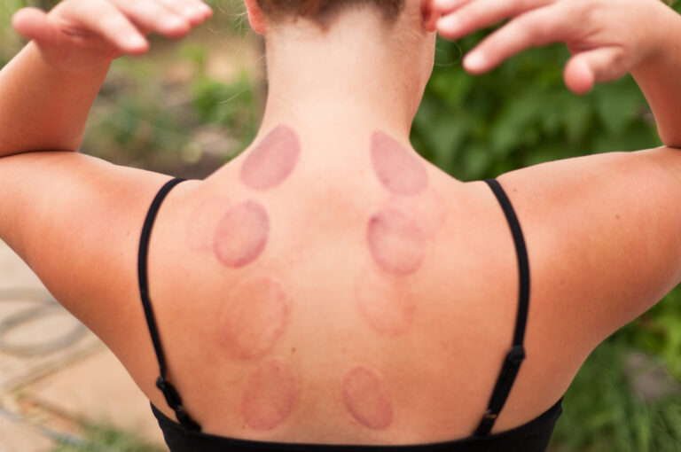 Wet Cupping or ‘Hijama’: The Ancient Muslim Art of Healing