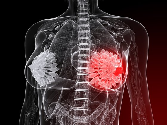 image breast cancer illustration smart bra