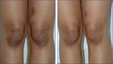 5 ways to lighten knee skin naturally