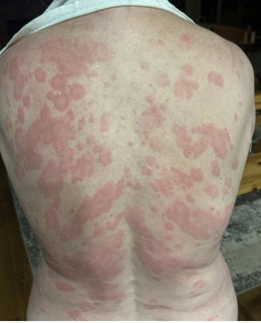 alpha-gal syndrome, alpha gal syndrome, tick bite, lone star tick, Amblyomma americanum, tick meat allergy, red meat allergy, alpha-gal allergy, tick saliva, tick feeding, food allergy, allergic reaction, tick-borne disease, beef allergy, pork allergy, mammalian meat allergy, CDC, entomology, ticks, Green Prophet