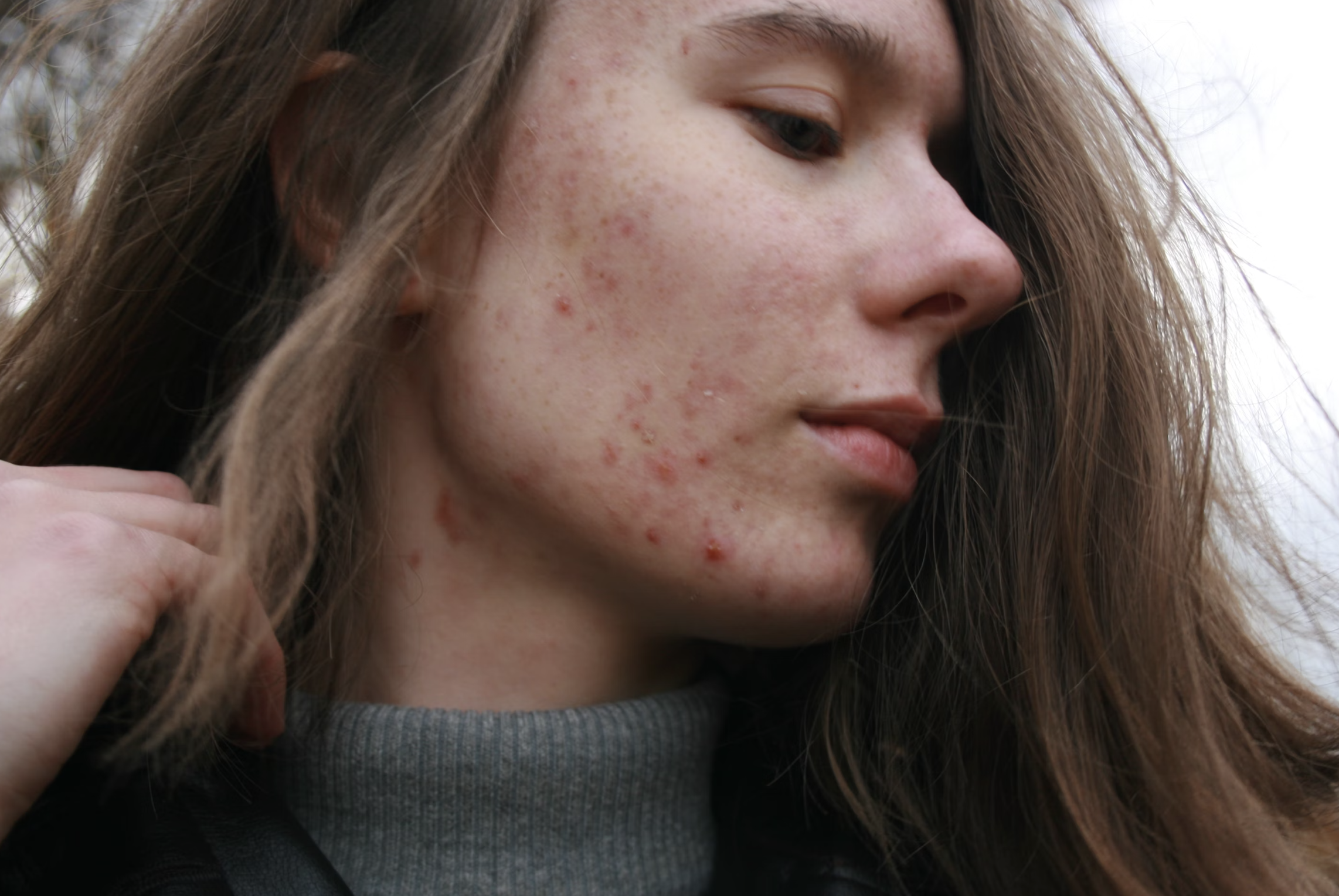 Thyme for treating acne