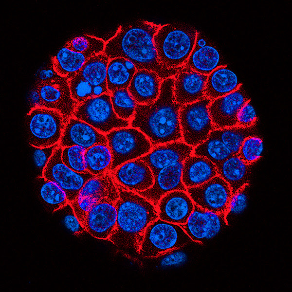 The success of daraxonrasib in pancreatic cancer offers hope against other cancers long-considered ‘undruggable’. (USC Norris Comprehensive Cancer Center/National Cancer Institute/SPL)