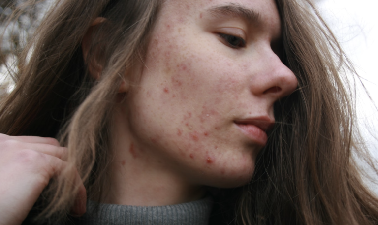 Benzene in Your Teen’s Acne Cream? What You Need to Know About the Hidden Carcinogen in Skincare Products