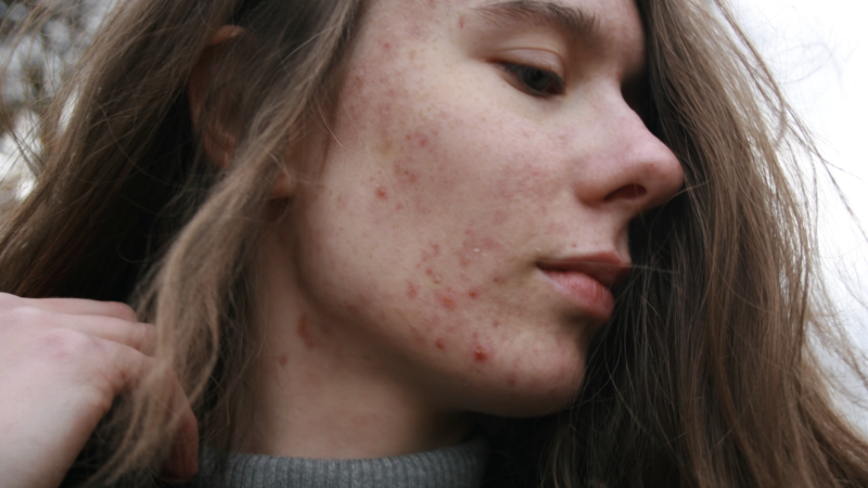 Benzene in Your Teen’s Acne Cream? What You Need to Know About the Hidden Carcinogen in Skincare Products