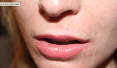 Can Herpes Kill Cancer? A Modified Virus Offers New Hope for Skin Cancer Patients