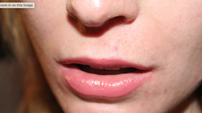 Can Herpes Kill Cancer? A Modified Virus Offers New Hope for Skin Cancer Patients